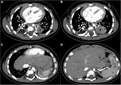 Case Report: An extremely rare case of double extralobar pulmonary sequestration with anomalous supplying arteries originating from the abdominal aorta in the left thoracic cavity